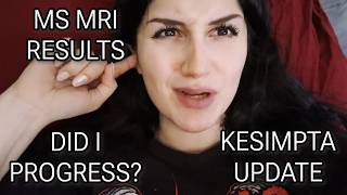 My Multiple Sclerosis MRI Results and Kesimpta Update