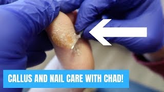 CALLUS AND NAIL CARE WITH CHAD!