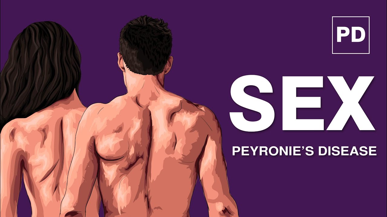 Peyronie’s Disease and Sex | The Impact of PD on your Sex Life | PD and