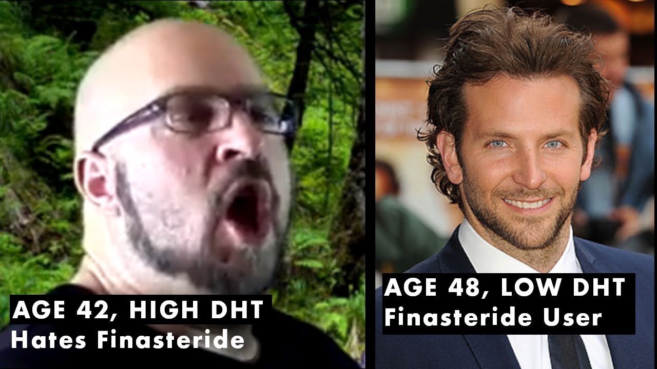 DHT Ages Your Skin And Makes You Ugly DHT Is A Trash Hormone Episode dht-ages-your-skin-and-makes-you-ugly-dht-is-a-trash-hormone-episode