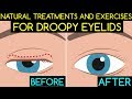 Natural Treatments and Exercises For Droopy Eyelids