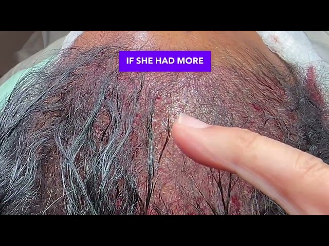 Complex Female Hair Transplant Recipient Design Explained by Dr. Lam