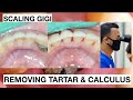 How Teeth Are Cleand At Dentist | General Dentist Griya RR