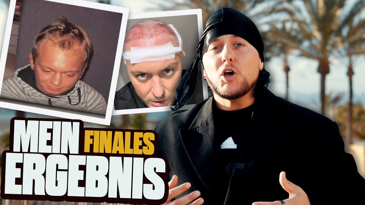 Ein Jahr nach meiner HAARTRANSPLANTATION in ISTANBUL | FAZIT!