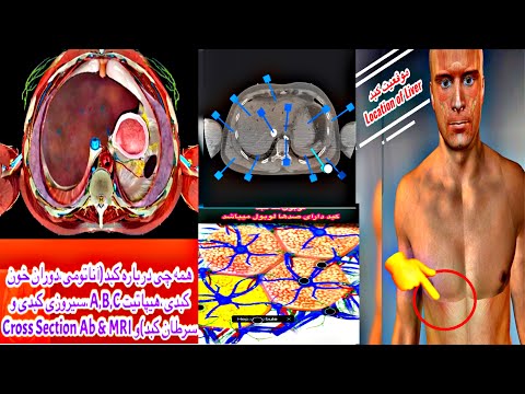 همه چی درباره کبد(آناتومی،دوران خون کبدی،Cross Section & MRI،هیپاتیت A,B,C،سیروزی کبدی و سرطان کبد)