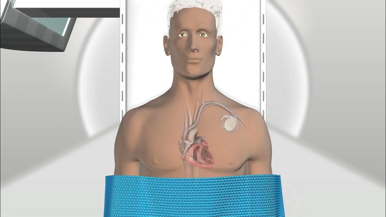 Medtronic Amplia MRI™ & Compia MRI™ SureScan® CRTDs YouTube