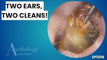 Hard Plug & Wet Wax Explained - EP1208