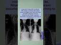 #Scoliosis #Strength — The Silent Weight of Patience