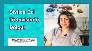 Sivilce İzi Tedavisinde Dolgu Doç.dr.zennure Takcı Anlatıyor