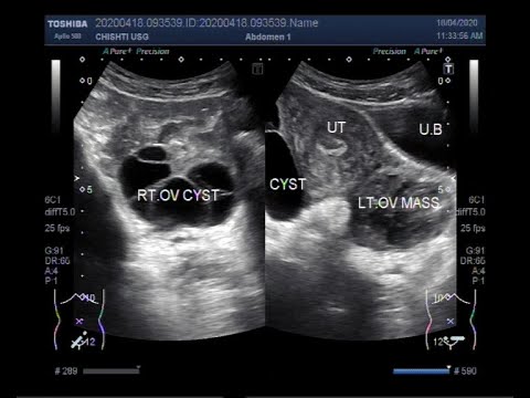 Ultrasound Video showing Two types of  Ovarian Cysts and an Ovarian Mass.