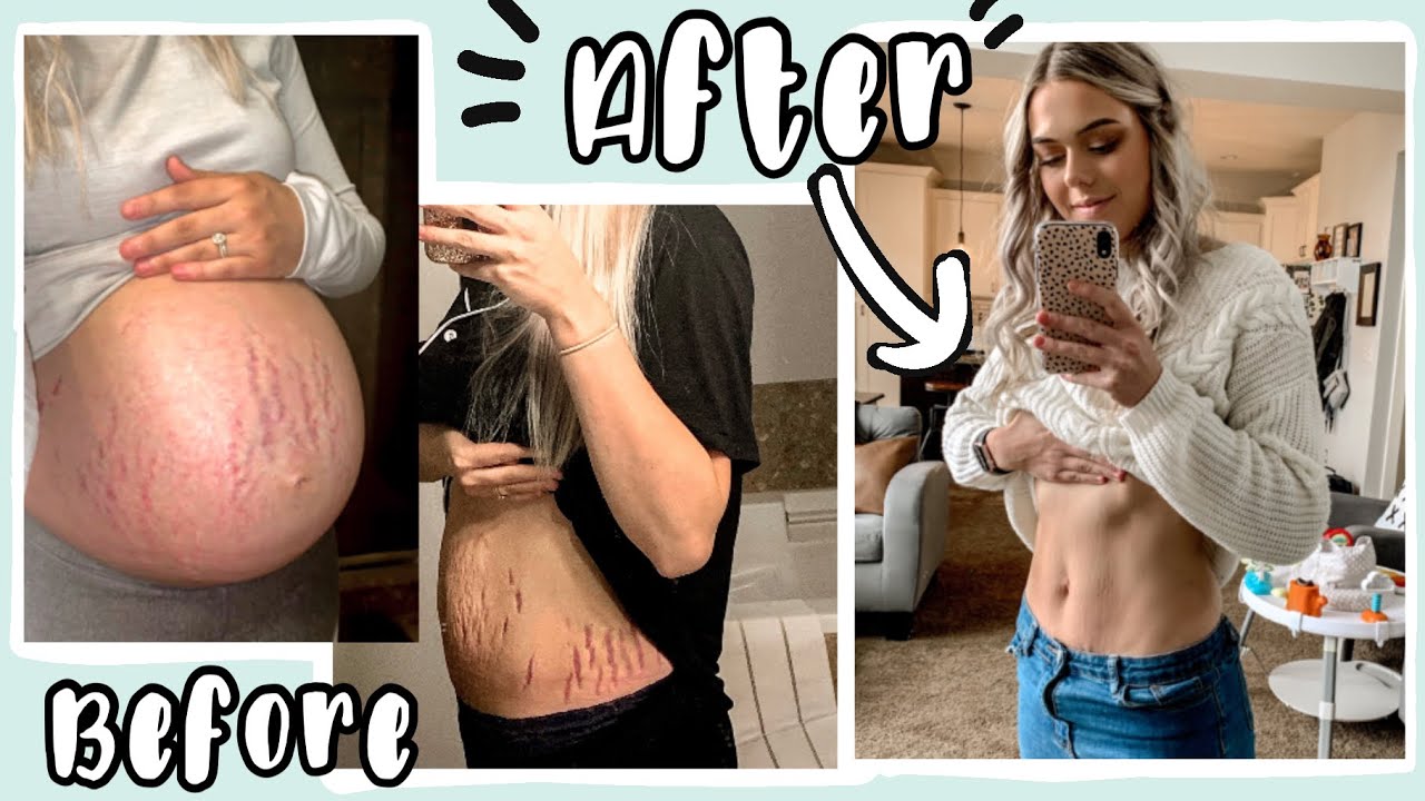 The BEST WAYS to reduce the looks of your POSTPARTUM STRETCH MARKS - 7 Tips + Tricks