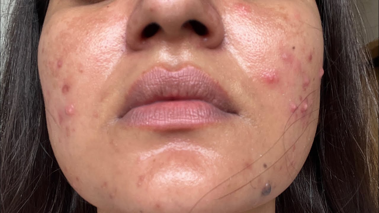 Tretinoin Day 25: What My Skin Looks Like + Tips – My Honest Skin Update