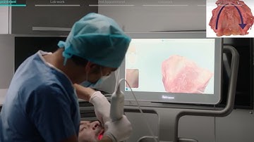 New iTero™ Denture Digital Workflow with Dr. Olivier Boujenah