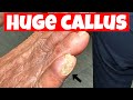 Pinch callus debridement