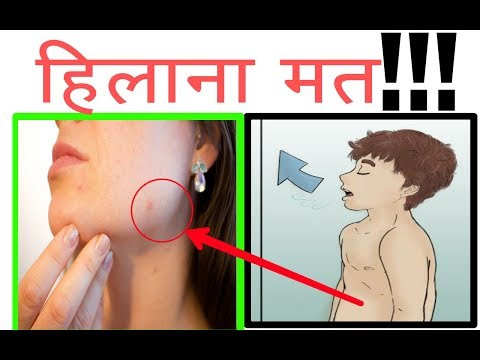 हिलाने से होते हैं पिंपल्स?? | Masterbation causes  pimples or acne[HINDI]