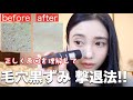 【毛穴黒ずみ抹殺】正しく原因を理解して、いちご鼻撃退！