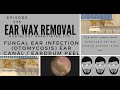 FUNGAL EAR INFECTION OTOMYCOSIS EAR CANAL & EARDRUM PEEL -  EP 375