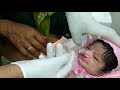 How to properly feed child with cleft lip and palate in English