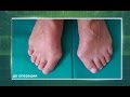 Hallux valgus – как вылечить это заболевание? - в программе "600 секунд о здоровье и красоте"