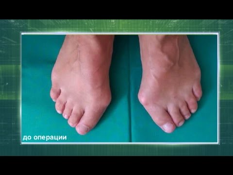 Video: Hallux Valgus I Knälederna