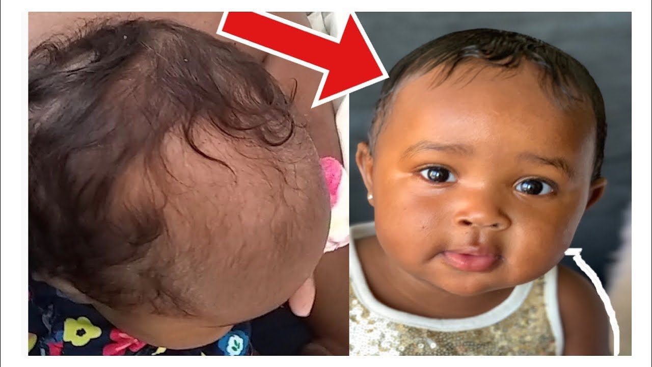 6 Causes Of Baby Hair Loss Treatment  4 Tips To Prevent It