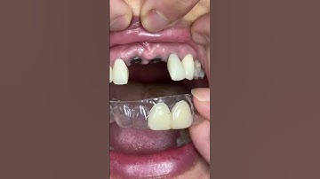 For temporary teeth for implants!