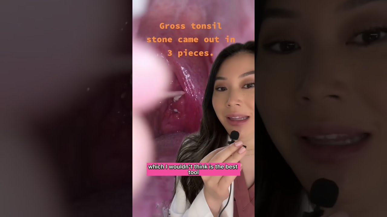 SKILLFULLY Removing Huge Juicy Tonsil Stones With A Sharp Wooden Pick Tonsilstones