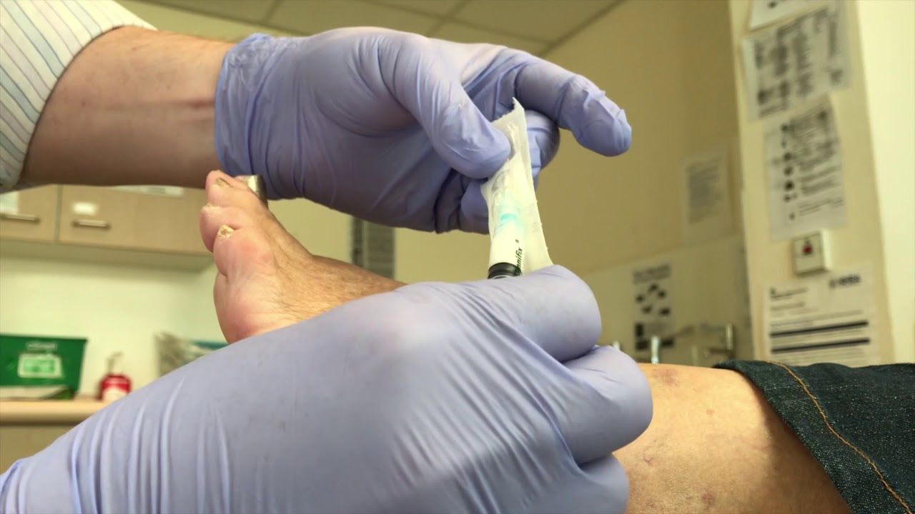 Injection left foot 3/4 Morton's neuroma YouTube