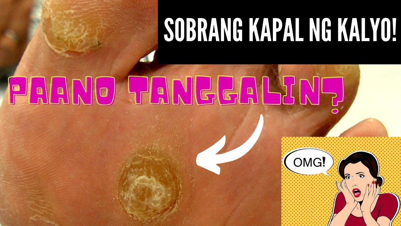 Callus and corn removal! YouTube