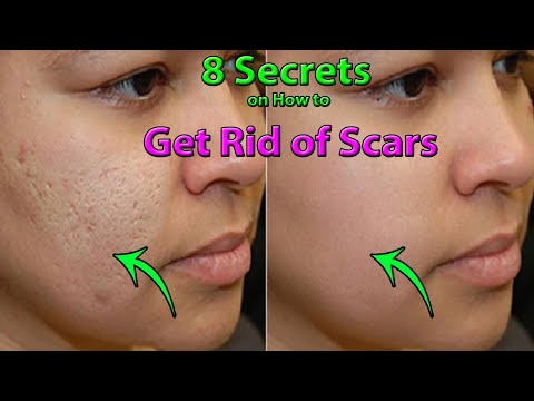8 Secrets on How to Get Rid of Scars Natural Life