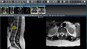 Automatic Spine Labeling - Saince Merge PACS