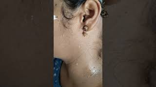 Skin tag removal #yash #beautyparlour#explore #moleremoval #vskbeautyparlourbridalstudio#pondicherry