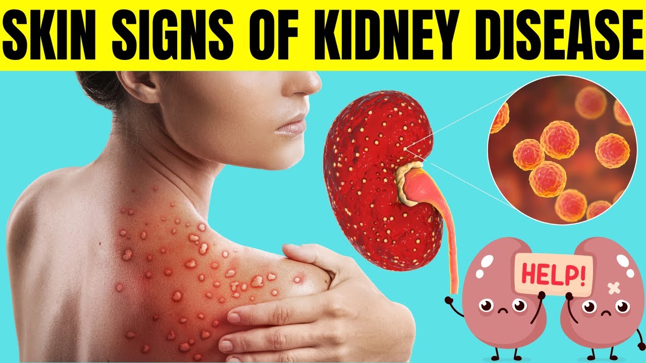 Skin Signs Of Kidney Disease Chronic Kidney Disease Kidney Failure skin-signs-of-kidney-disease-chronic-kidney-disease-kidney-failure