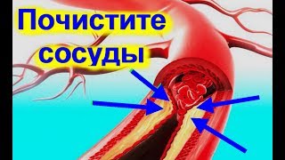 Как очистить сосуды с помощью 2-х продуктов. Почистите сосуды.Очиститься и как похудеть | #edblack Как очистить сосуды с помощью 2-х продуктов. Почистите сосуды.Очиститься и как похудеть | #edblack