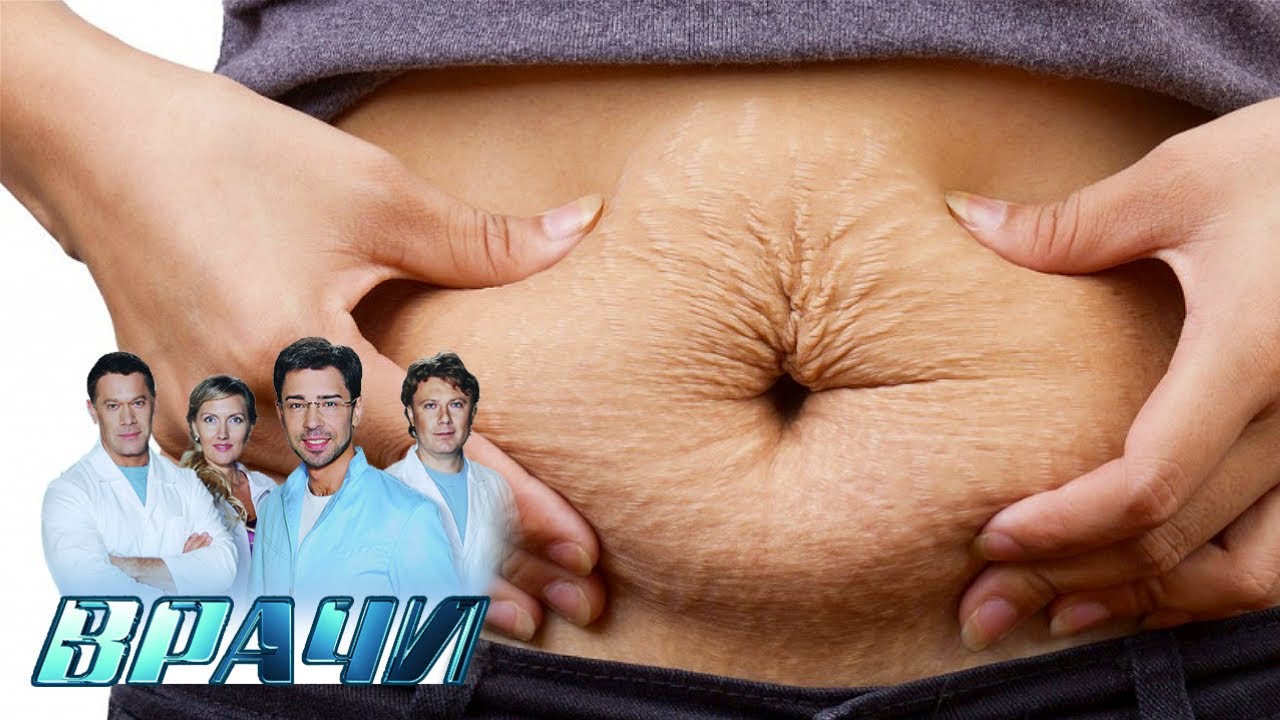 Как избавиться от растяжек после беременности. “Врачи“ - YouTube