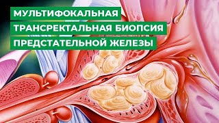 Мультифокальная трансректальная биопсия предстательной железы