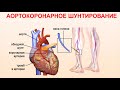 Атеросклеротические бляшки: как избавиться от атеросклероза