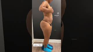 Before And After Lipo 360 S.atlantaliposuction Call Us At 770-416-0000