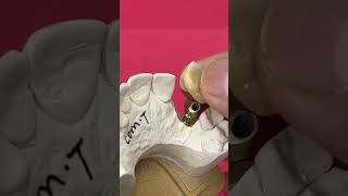Anterior Pontic Bridge Implant #dentist #dental #shortvideo #shorts #short #smile
