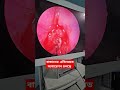 এডিনয়েড অপারেশন #এডিনয়েড_অপারেশন #বাচ্চাদের_এডিনয়েড_অপারেশন_কিভবে_করা_হয় #নাক_কান_গলা