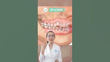 Mô phỏng quá trình niềng răng móm #shorts