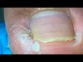 Huge Broken Ingrown Toenail, Successfully Dug Out