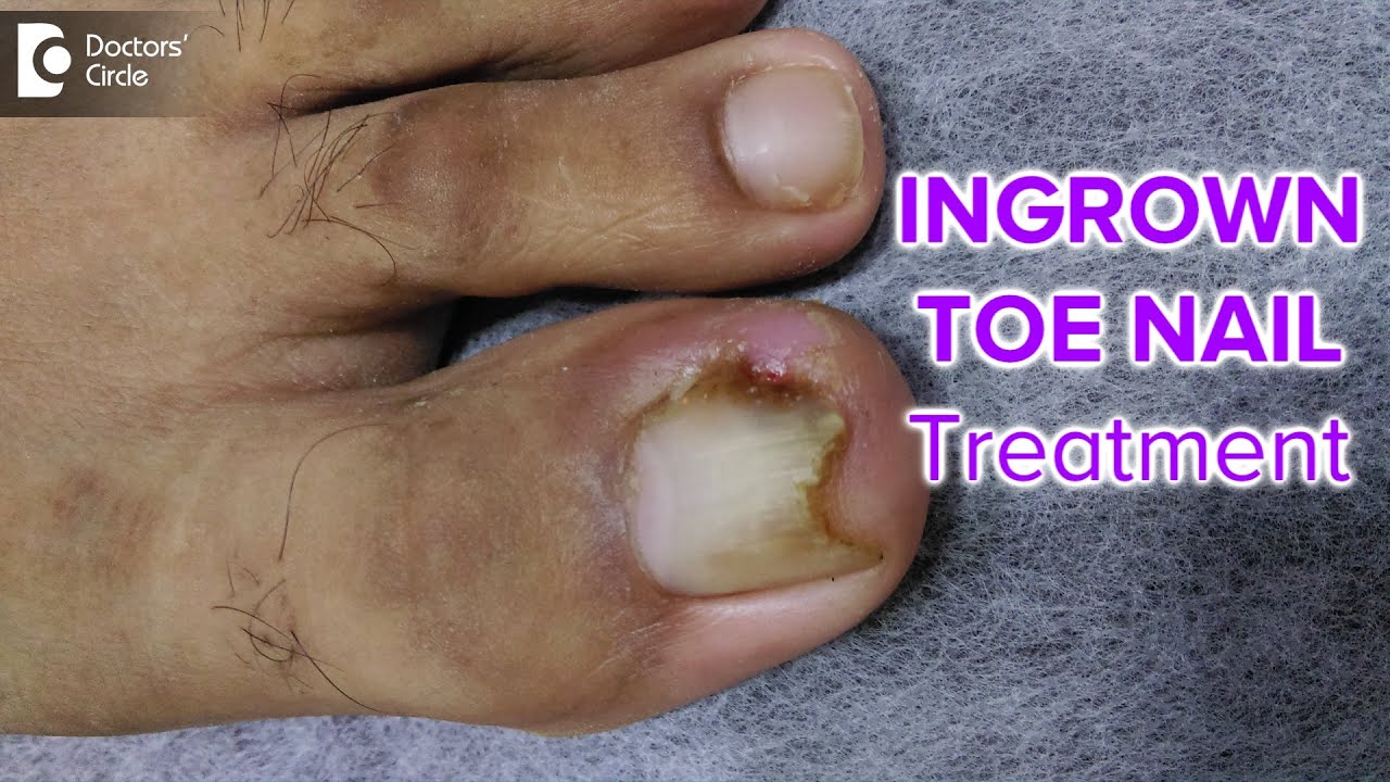 INGROWN TOE NAIL | Infection, Causes, Treatment & Procedures -Dr. Deepak P  Devakar | Doctors' Circle - YouTube
