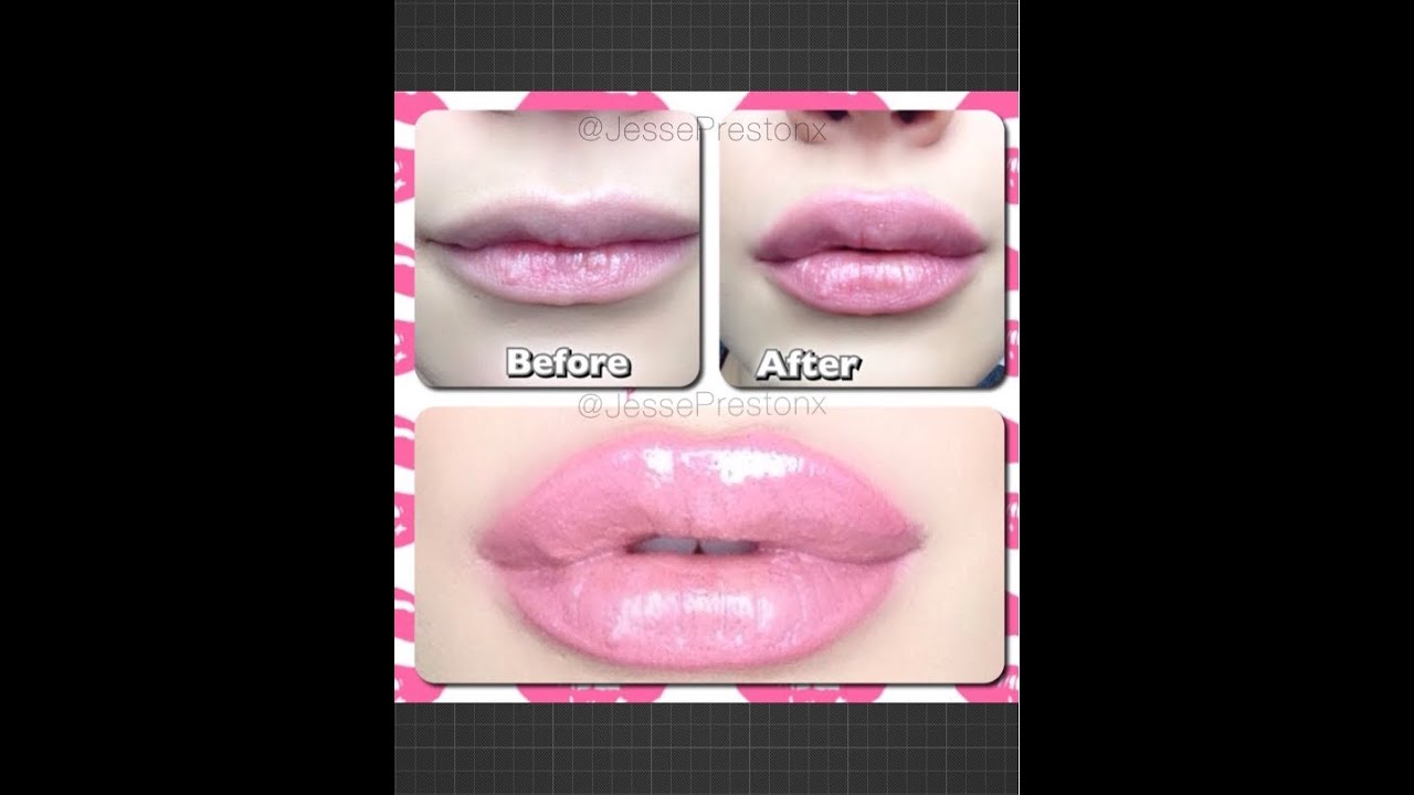 With lips how get fuller near to me injections