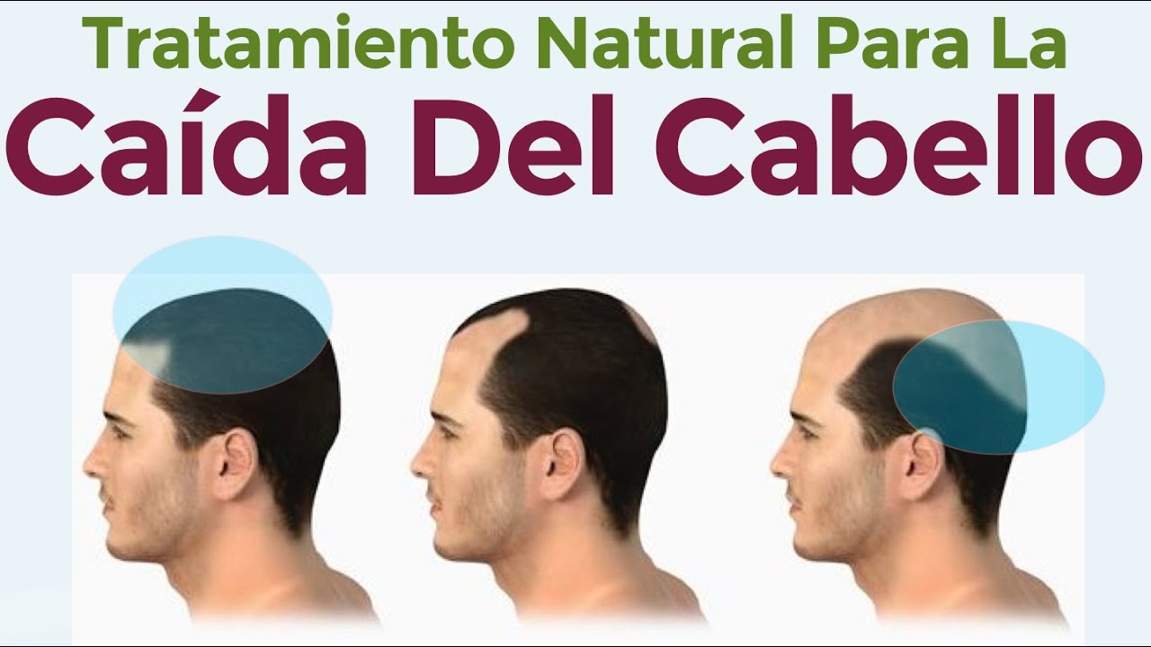 Sabor ecuación Aplaudir El Mejor Tratamiento Natural Contra La Caída Del Cabello - Como detener la calvicie - YouTube Sabor ecuación Aplaudir El Mejor Tratamiento Natural Contra La Caída Del Cabello - Como detener la calvicie - YouTube