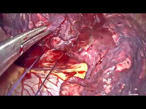 Uniportal VATs Right Lower lobectomy for Stage 1 primary lung cancer.