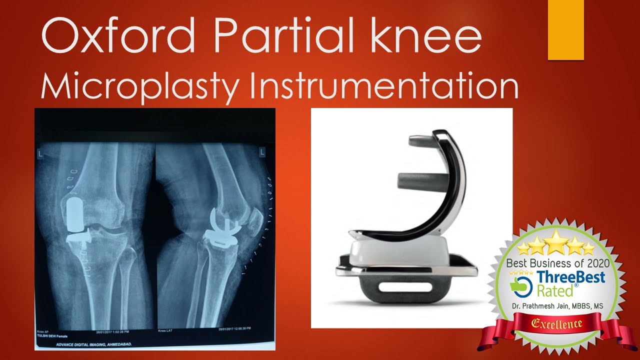 Oxford Partial Knee Microplasty Unicondylar Knee Instrumentation - YouTube