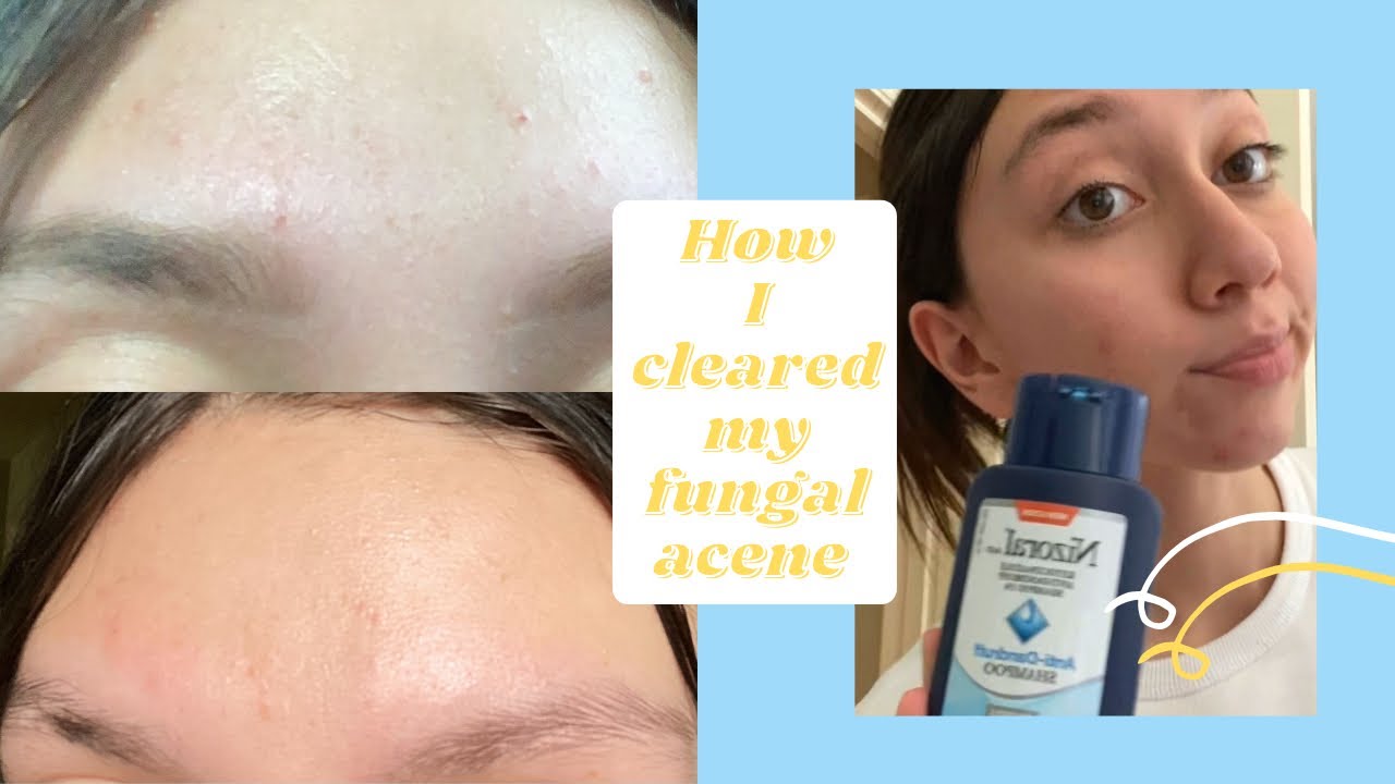 which nizoral to use for fungal acne