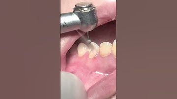 Tooth rebuild with fiber post and composite restoration #dentist