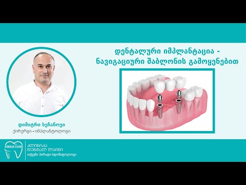 დენტალური იმპლანტაცია - ნავიგაციური შაბლონის გამოყენებით I დენტალ ლაინი